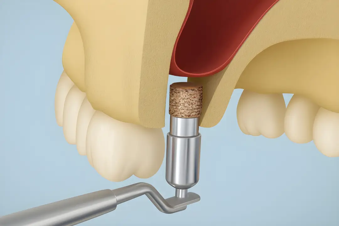Sinus Lifts