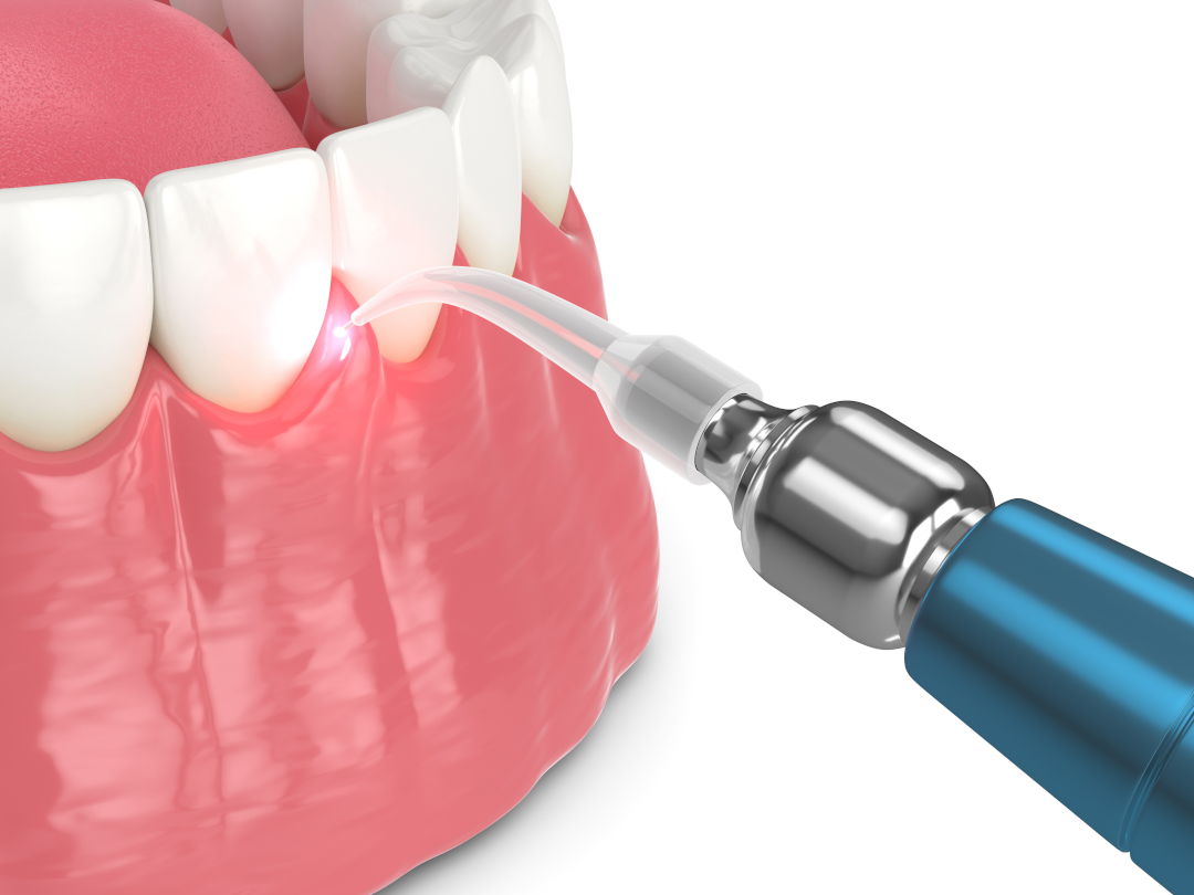 Gum Recontouring