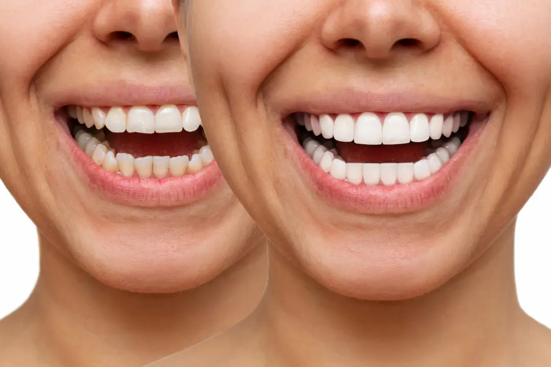 Dental Veneers